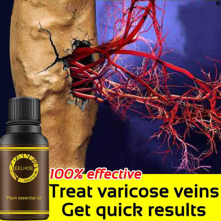 [Doctor Varicose Vein Oil Varicose Veins Remover Effective