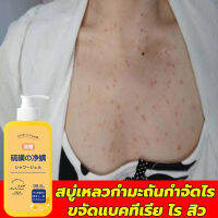 300ml สบู่เหลวกำมะถันสูตรอ่อนโยน เหมาะสำหรับผิวที่เป็นสิว มีอาการคัน ชะล้างสิ่งสกปรก ฆ่าเชื้อแบคทีเรีย ให้ความชุ่มชื่น ลบสิวควบคุมน้ำมัน ปรับสี ขจัดกลิ่นเหงื่อ