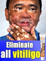 Effectively Remove Vitiligo Ointment Remove Ringworm White Spot Removal Skin Vitiligo Eliminate Vitiligo Skin Care