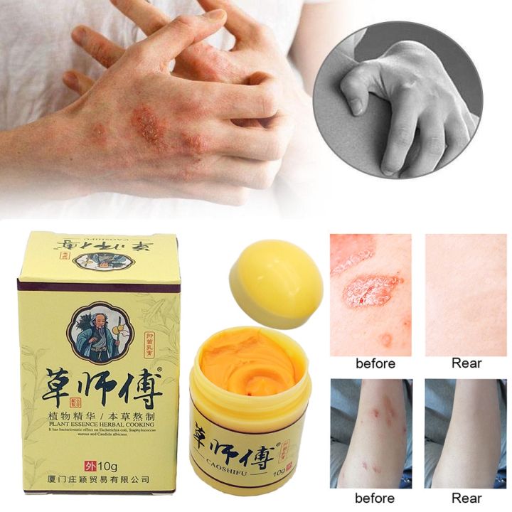 Eczema Psoriasis Treatment Cream Topical Medicated Chinese Traditional