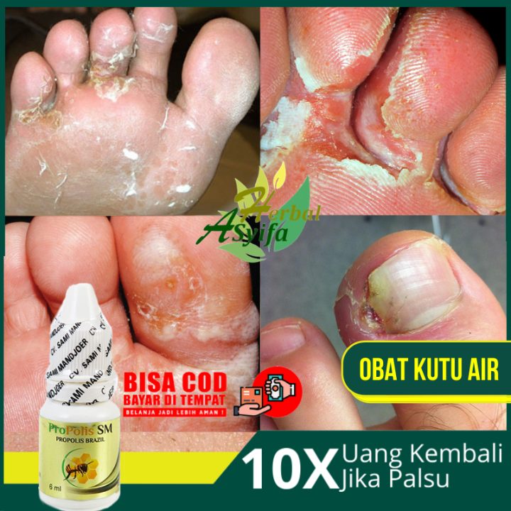 Obat Kutu Air Obat Untuk Kutu Air Penghilang Kuman Air Jamur Kutu Air Menghilangkan Kutu 3771