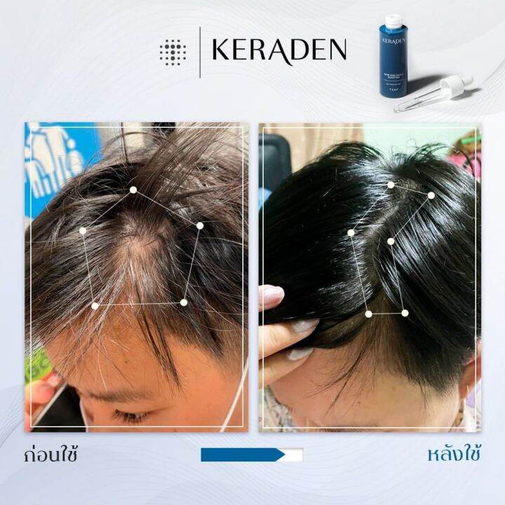 keraden-serum-เคราเดน-เซรั่ม-บำรุงผม-ให้แข็งแรง-ไม่หลุดร่วง-เพิ่มผมงอกใหม่-ขนาด-30-มล-จำนวน-1-ขวด