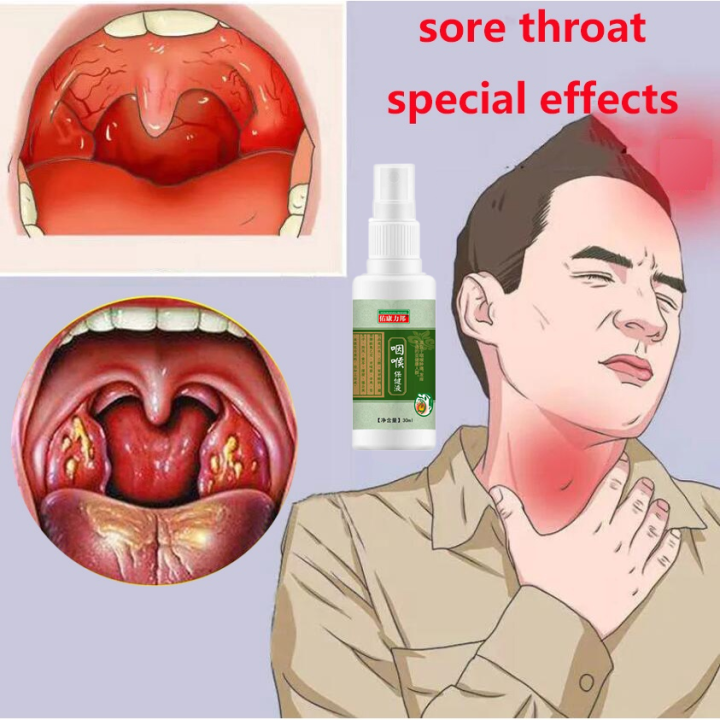 Sore Throat Spray 30ml Acute Chronic Pharyngitis Cream Cough