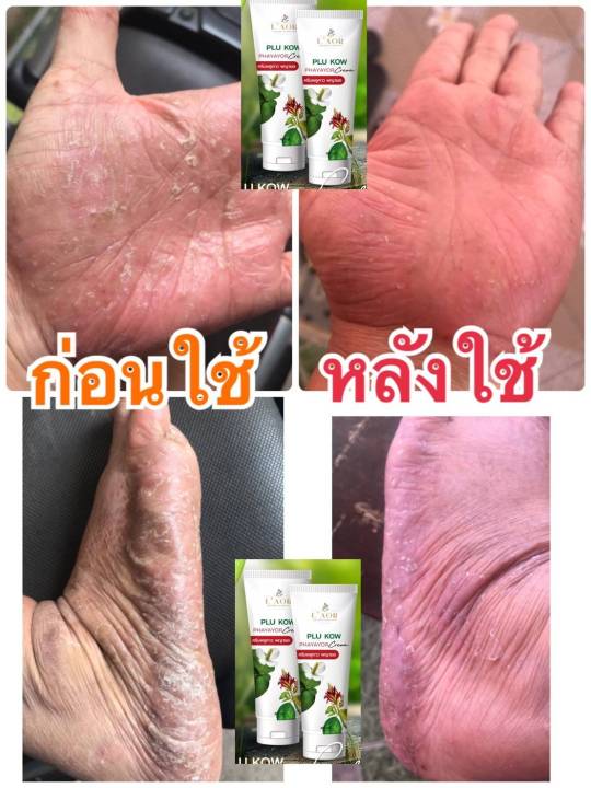 โปรพิเศษ-ครีมพลูคาว-พญายอ-ขนาด-40ml-2-หลอดราคาพิเศษ-เหมาะกับผู้ที่มีปัญหาโรคผิวหนัง-แก้สิวเม็ดผดผื่นคัน-รักษาเริม-งูสวัด