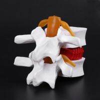 * Human Anatomical Lumbar Disc Herniation Model