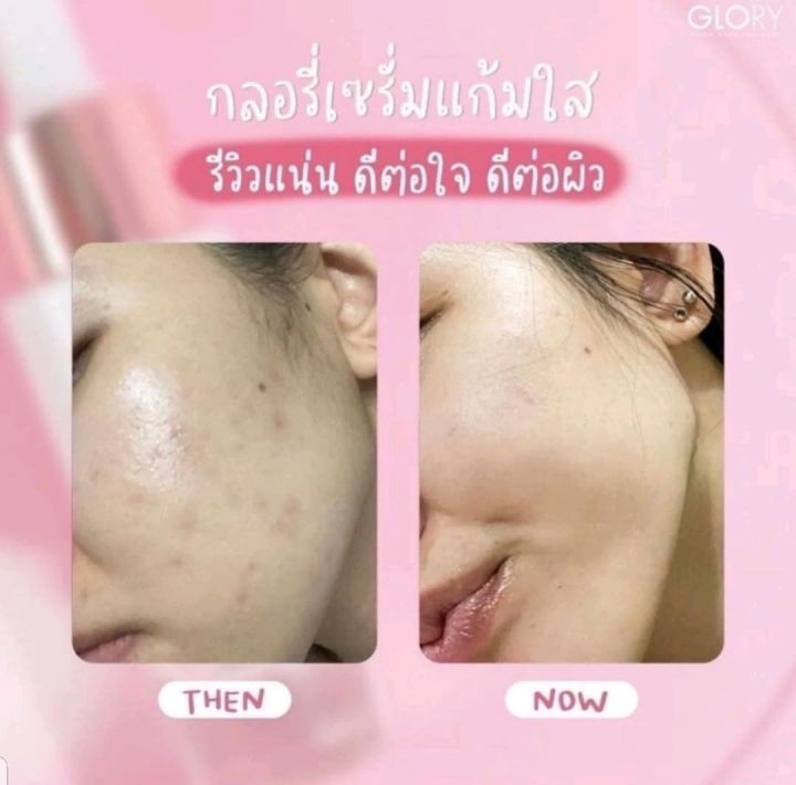 พร้อมส่ง-เซรั่มแก้มใส-เซรั่มกลอรี่-กลอรี่เซรั่มแก้มใส-glory-advanced-glow-skin-booster-serum-ผิวใสเร่งด่วนภายใน24ชม-ลดการเกิดสิว