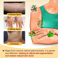 Vitiligo Treatment Ointment Improve Skin Pigmentation Antibacterial Cream Reduces White Spots On Skin