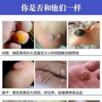 Gram wart liquid pen wart Ling Ling condyloma acuminatum ordinary wart corns thorn plantar wart hand foot neck armpit special effect liquid cream