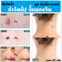 กำจัดไฝ ขี้แมลงวัน กำจัดถึงราก ไม่เกิดซ้ำ ขนาด 20g.