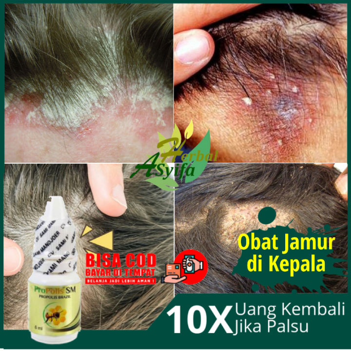 Obat Jamur Kulit Kepala Tinea Kapitis Obat Infeksi Jamur Di Kepala Capitis Penghilang Jamur 0995