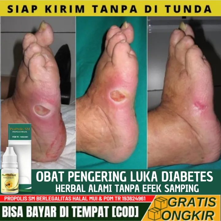 Obat Pengering Luka Diabetes Melitus Basah Luka Yang Sudah Bernanah