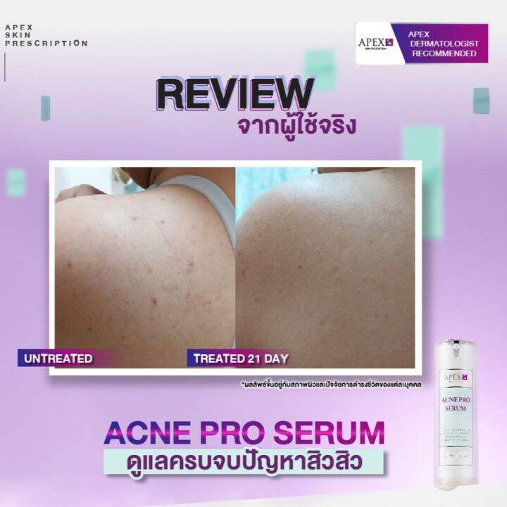 apex-sx-acne-pro-serum-เซรั่มรวมการดูแลปัญหาต่างๆ-ของการเกิดสิวไว้ในขวดเดียว-เหมาะสำหรับคนเป็นสิว-อ่อนโยนมาก-30-ml