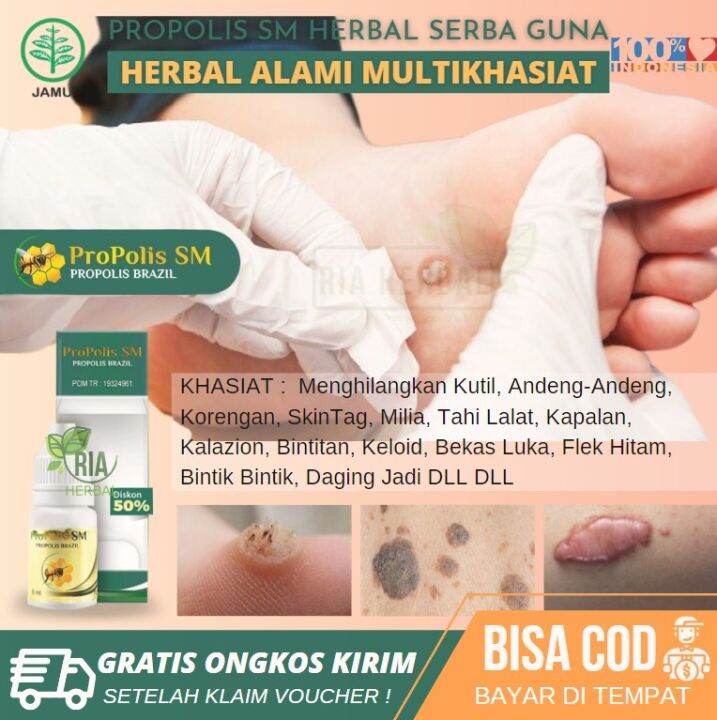 Solusi Melenyapkan Skin Tag, Kutil, Bintit, Benign, Atypical Moles