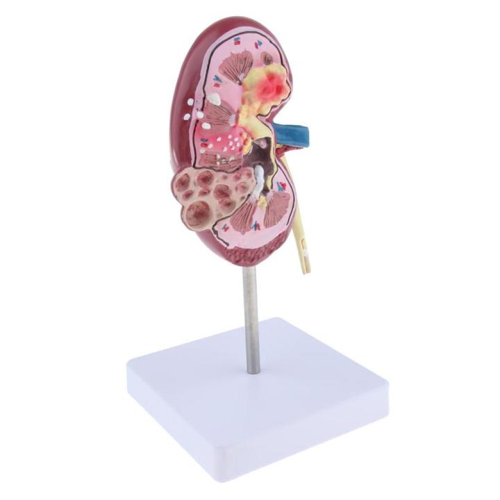 อวัยวะทางการแพทย์ไตกายวิภาครุ่น-lesion-ไตรุ่นมนุษย์กายวิภาคศาสตร์การเรียนการสอนอุปกรณ์