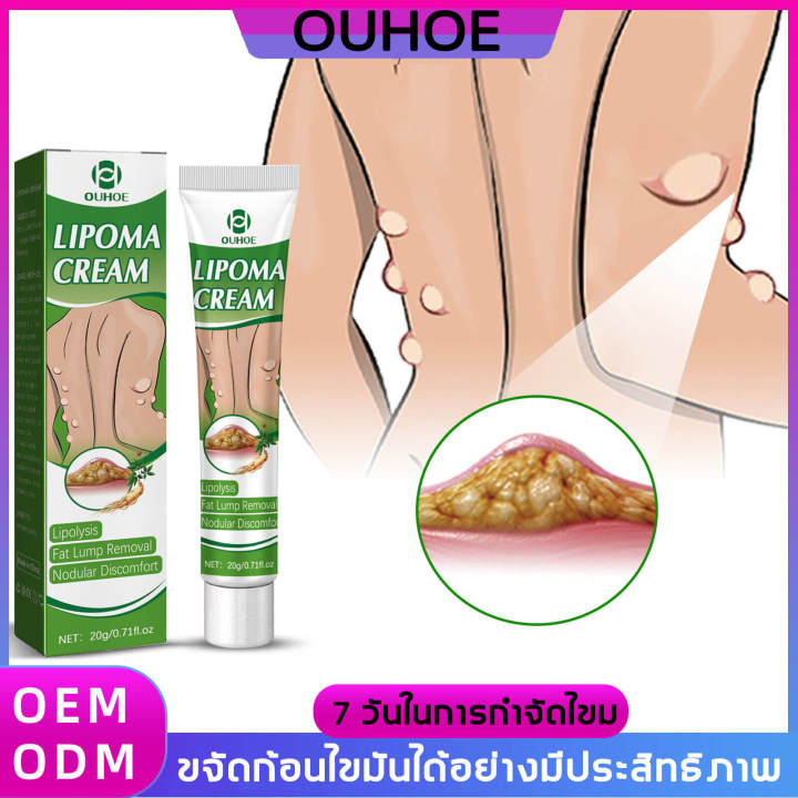 lipoma-removal-cream-ครีมก้อนเนื้องอกไขมัน-ครีมทาเนื้องอกไขมันกำจัดปัญหาใต้ผิวหนัง-ก้อนไขมันแข็ง-เนื้องอกไขมัน-สมุนไพรกำจัด-ก้อนเนื้อใต้ผ