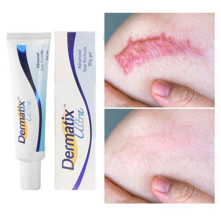 Effective Dermatix Scar Removal Cream Scar Gel Acne Scars Treatment Old