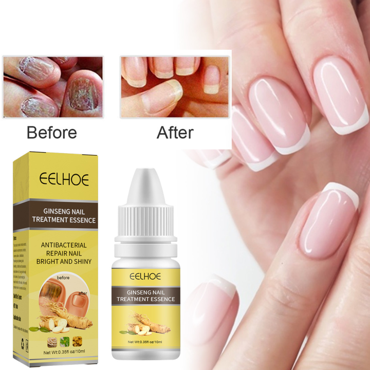 EFERO Nail Fungus Serum Anti-fungal Nail Serum Nail Fungus Removal Toe ...