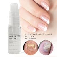 20ml Natural Powerful Nail Repair Essence ต่อต้านเชื้อราเล็บ Treatment โซลูชั่นการซ่อมแซมที่มีประสิทธิภาพ