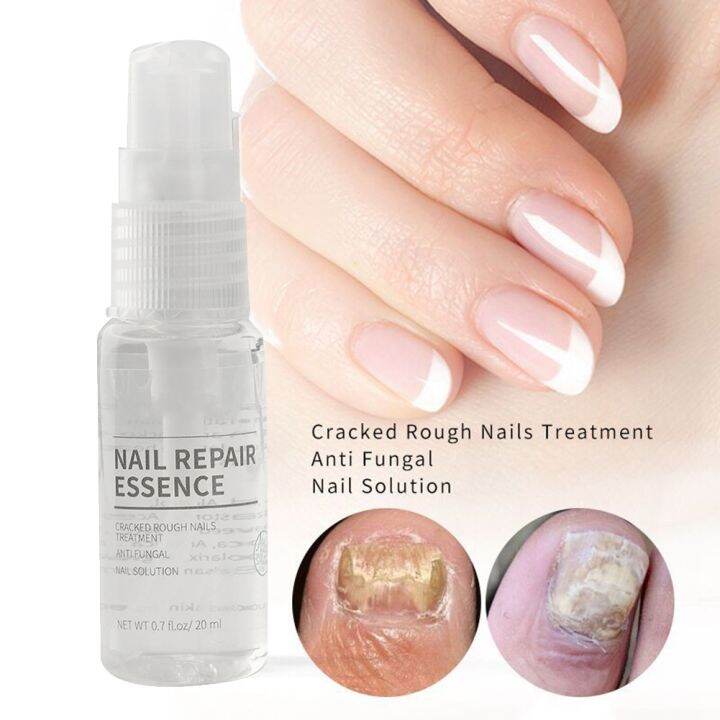 20ml Natural Powerful Nail Repair Essence ต่อต้านเชื้อราเล็บ Treatment