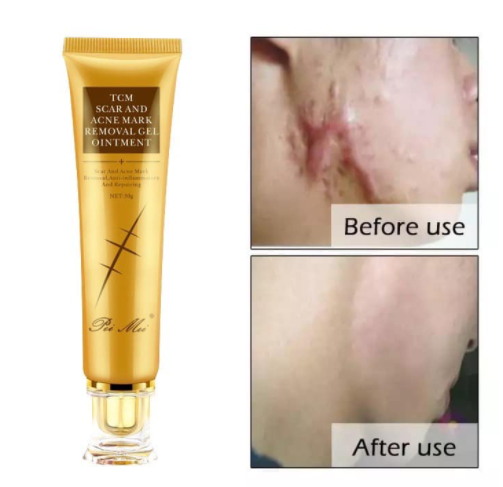 Picture of 30g Scar Removal Cream Acne Scar Remover Stretch Mark Remover Legs ...