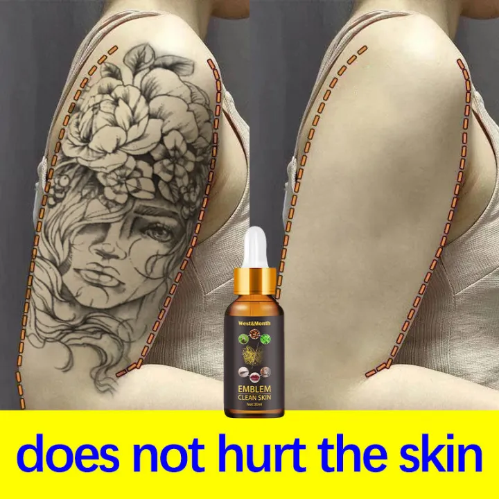 Tattoo Removal Cream Does It Really Work Plus Other Removal Methods