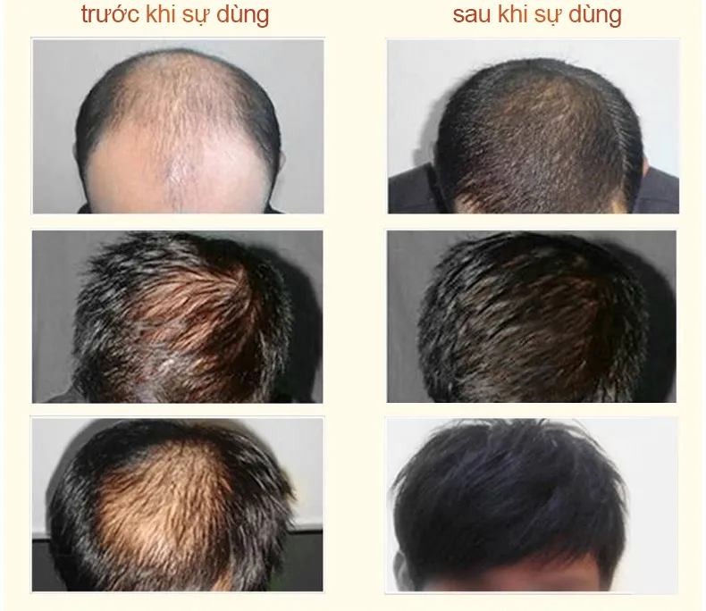 Nguyên nhân gây rụng tóc ở nam có thể bạn chưa biết  Doppelherz