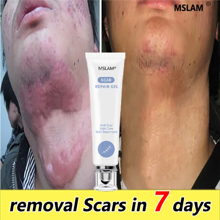 Don't waste your money on creams that don't work MSLAM Repair Scar