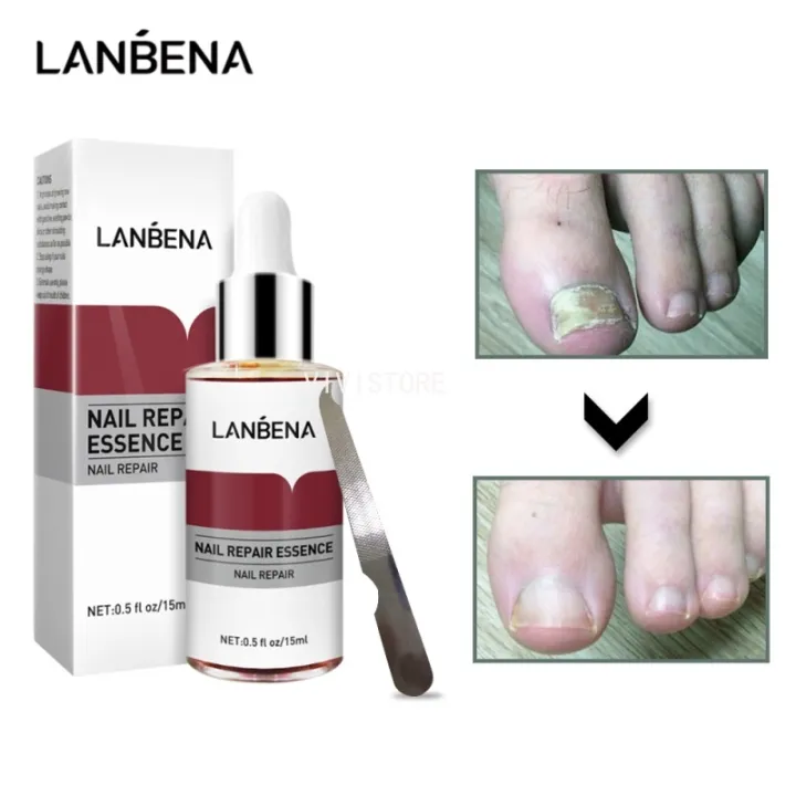 LANBENA Nail Repair Essence Serum Fungal Nail Treatment Remove Onychomycosis Toe Nourishing