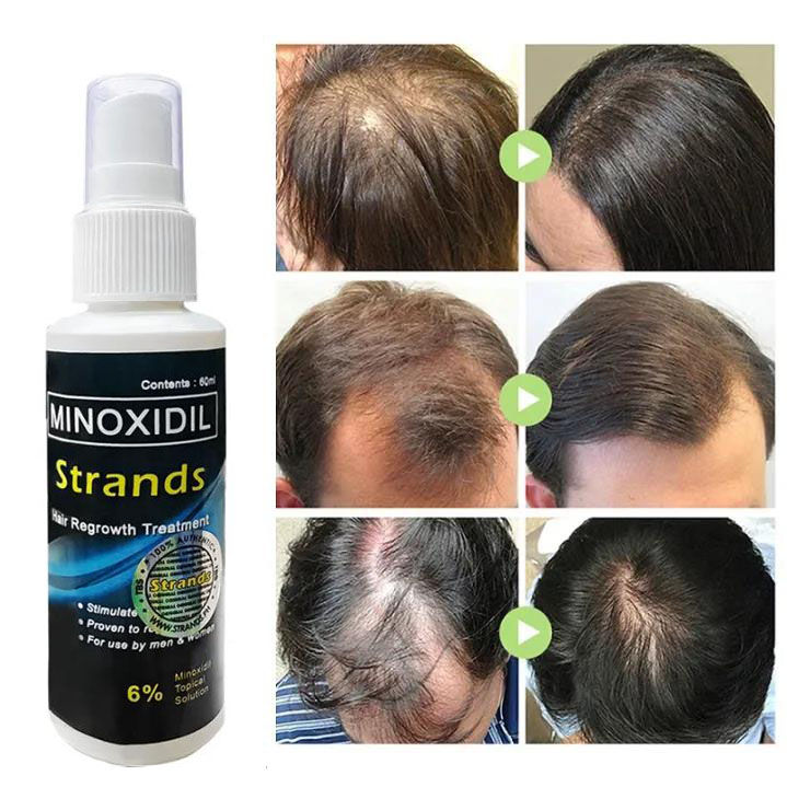 Minoxidil Strands 6% Minoxidil Topical Solution (60ml per bottle) Hair ...