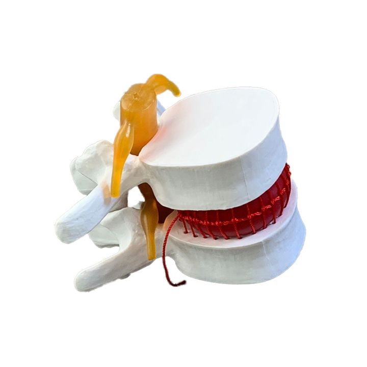 zheng-river-extrusion-model-of-lumbar-prominent-vertebral-spine-human-body-bone-bonesetting-massage-medical-demonstration-teaching