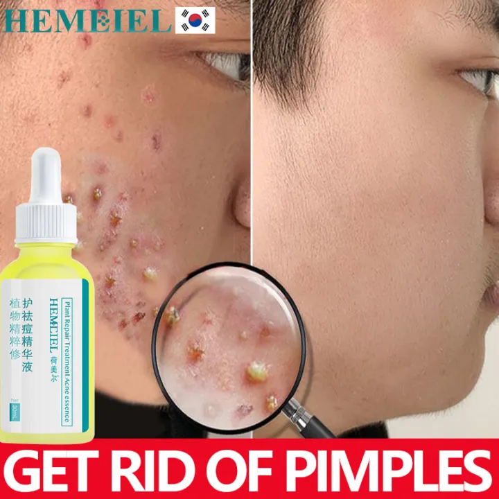 HEMEIEL Tretinoin Cream Original/Pimple Eraser Quick Fx/Anti Acne And