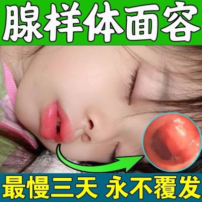 Adenoid hypertrophy traditional Chinese face corrector conditioning children nasal congestion snoring open mouth sleep ventilation difficult stickers