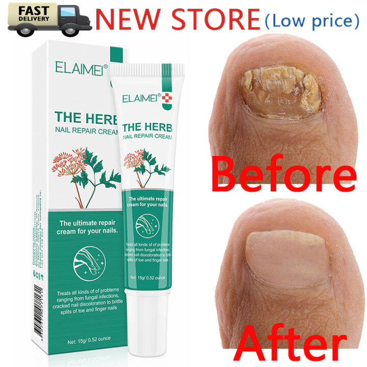 15g Nail Repair Cream Ointment For Nail Fungus Treatment Fingernail