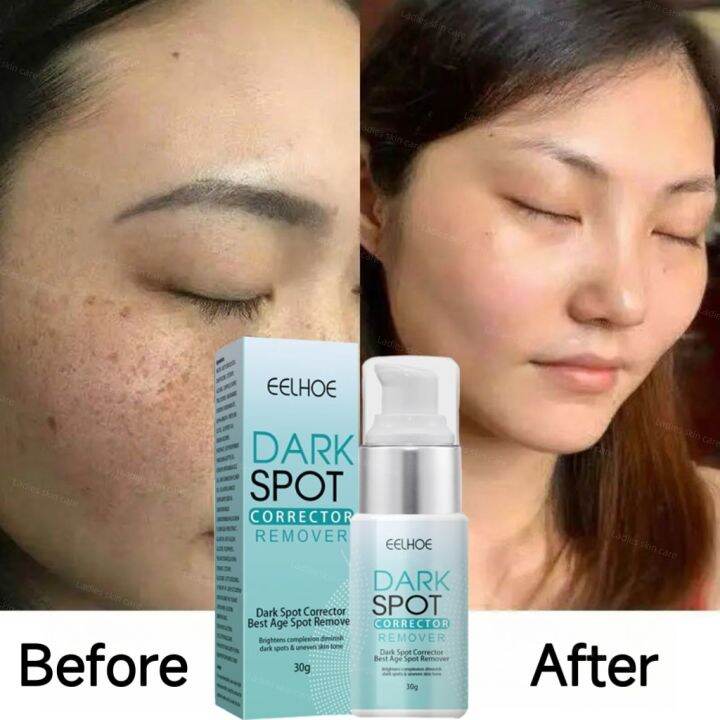 Eelhoe Dark Spot Remover Cream Moisturizing Brighten Improving Uneven