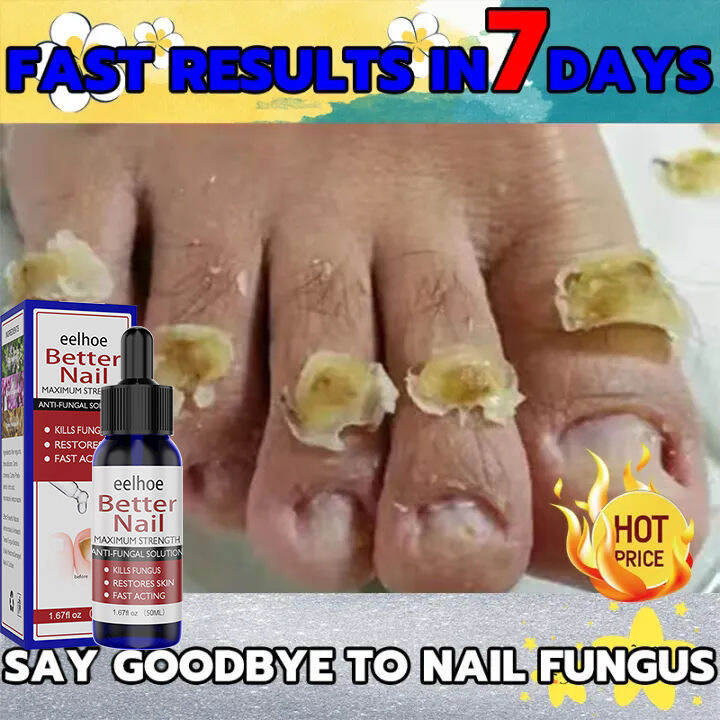 7 days remove onychomycosis Eelhoe Nail repair treatment cream 50ml