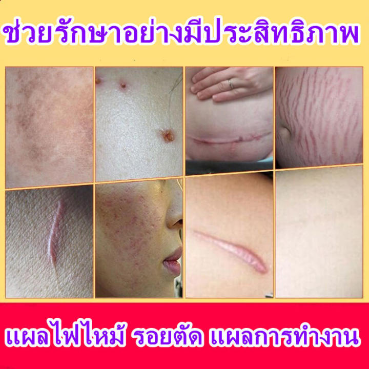 ครีมลดรอยแผลเป็น-ครีมรักษาแผลเป็น-ครีมซ่อมแซมรอยแผลเป็น-scar-removal-cream-ครีมซ่อมแซม-รักษาแผลเป็น-แผลไฟไหม้-แผลผ่าตัด-แผลน้ำร้อนลวก