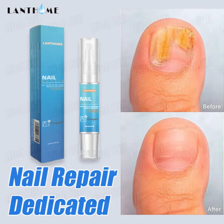 LANTHOME Nail Repair Anti Fungal Nail Repair Liquid Repair Tools Foot
