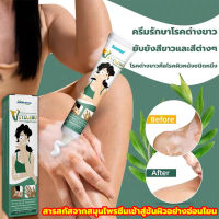 ?7วัน เห็นผล?South Moon ครีมทาด่างขาว 20g สารสกัดจากสมุนไพร ไม่ระคายเคือง ใช้ได้ทั้งร่างและทุกวัย ผลิตภัณฑ์กระตุ้นการสร้างเม็ดสีของผิว โรคด่างขาว โรคผิวหนัง ผลิตภัณฑ์ Vitiligo ด่างขาวที่หน้า ด่างขาวที่หลัง ด่างขาวที่แขน ด่างขาวที่ขา ยาด่างขาว