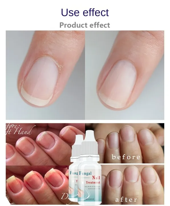 LANTHOME Nail Repair Essence Serum Nail Treatment Nail Care Fungal Nail