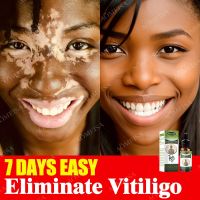 【CC】 Herbal Extract Vitiligo Ointment Remove Ringworm White Spot Removal Skin Eliminate