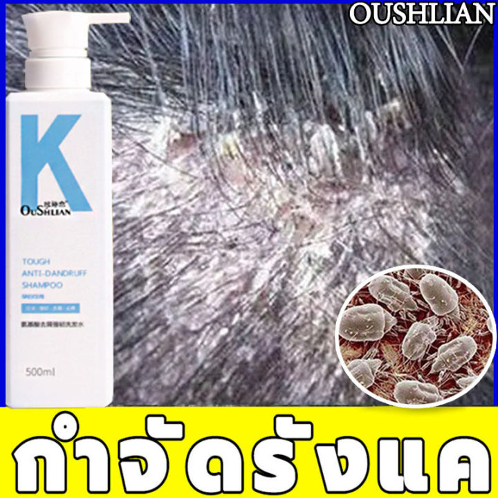 ป้องกันรังแค-ควบคุมความมัน-oushlian-แชมพูแก้ผมร่วง-ลดอาการคัน-แชมพูขจัดรังแค-ครีมนวดผม-ผม-บำรุงหนังศีรษะ-ครีมหมักผม-แชมพู