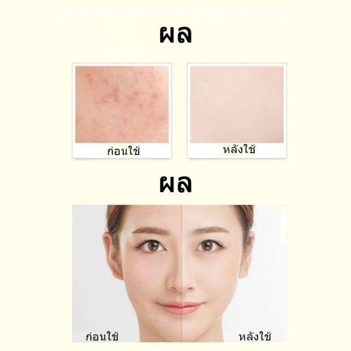 เวอร์บีน่า-pore-essence-สูตรช่วยลดสิว-ช่วยควบคุมความมัน-ช่วยกระชับรูขุมขน-บอกลาปัญหาสิว-ขนาด-เซรั่มบำรุงผิวกระชับรูขุมขน