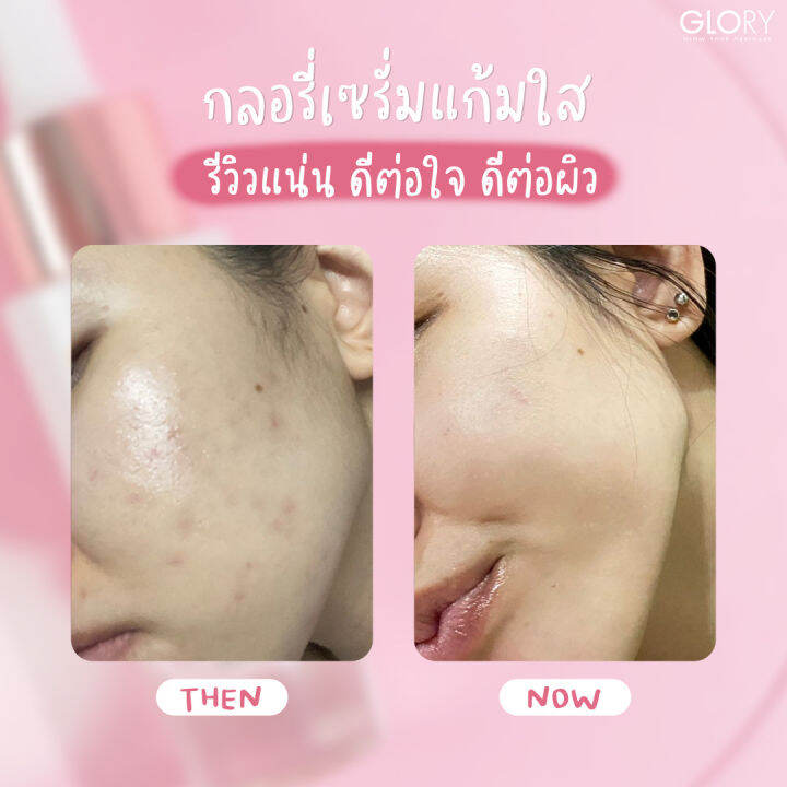 ส่งฟรี-เซรั่มกลอรี่-เซรั่มแก้มใส-glory-serum-pauseile-ลดรอยสิว-จางไวมาก-สิว-ปรับผิวเนียน-ขาวใส