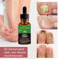 50ml nails Care Repair NAIL fungal Anti-fungus Onychomycosis-removal Liquid Ginger Foot antifungal na. ซองสลับที่ละเอียดอ่อน