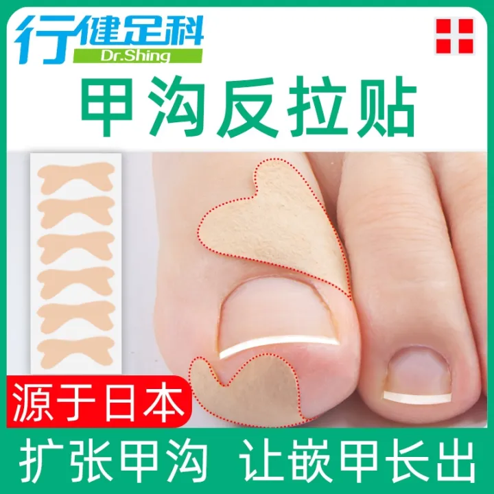 A ditch ingrown nail orthotics patch inflammation children nail stick
