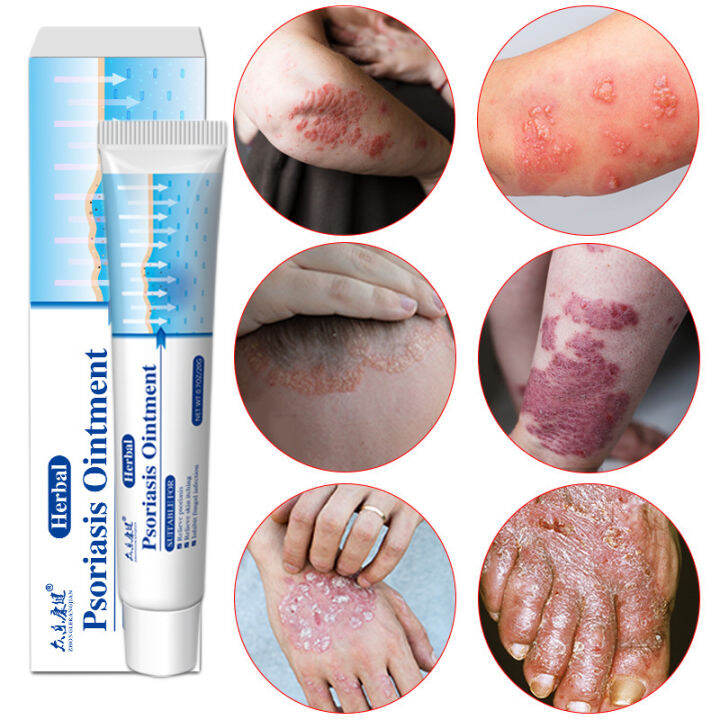 100 Original Psoriasis Eczema Cream Psoriasis Creams AntiItch Cream Acne Keratosis Dermatitis