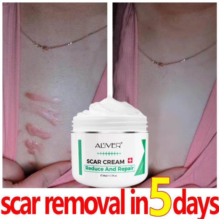 100 Effective Aliver Scar Removal Cream Scar Remover For Old Scar On