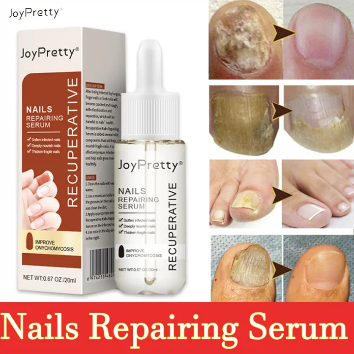 Joypretty Nail Repair Liquid Nail Care Nail Fungus Treatment Nail Care  Essential Oil Anti-fungal Nail