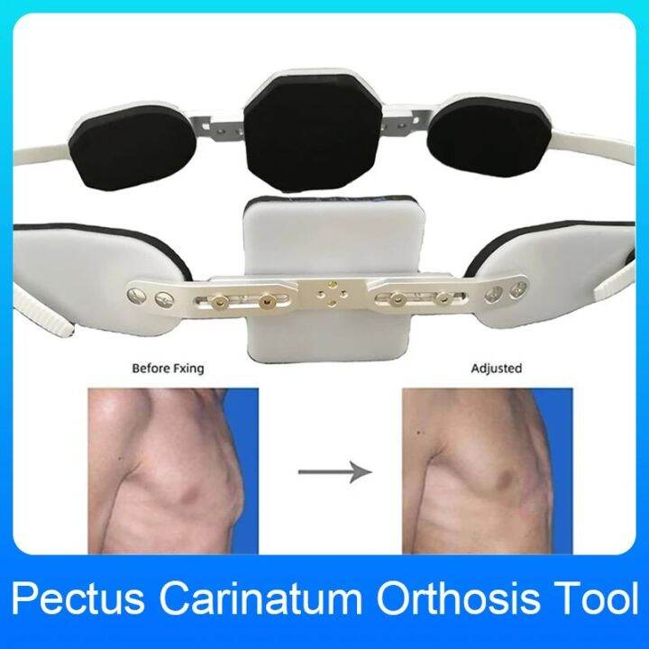 Adjustable Pectus Carinatum Orthosis Brace Pigeon Chest Orthosis