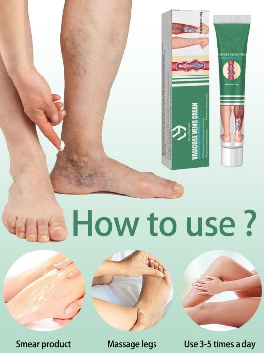 ครีมสำหรับเส้นเลือดขอดที่เท้า-s-มีประสิทธิภาพเส้นเลือดขอดที่เท้าครีม-relief-เพื่อบรรเทาการรักษาอาการปวดแมงมุม-vasculitis-phlebitis